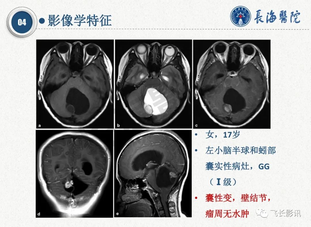 影像PPT - 【PPT】脑节细胞胶质瘤的诊断及鉴别诊断-32