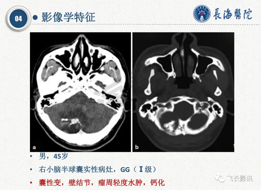 影像PPT - 【PPT】脑节细胞胶质瘤的诊断及鉴别诊断-33