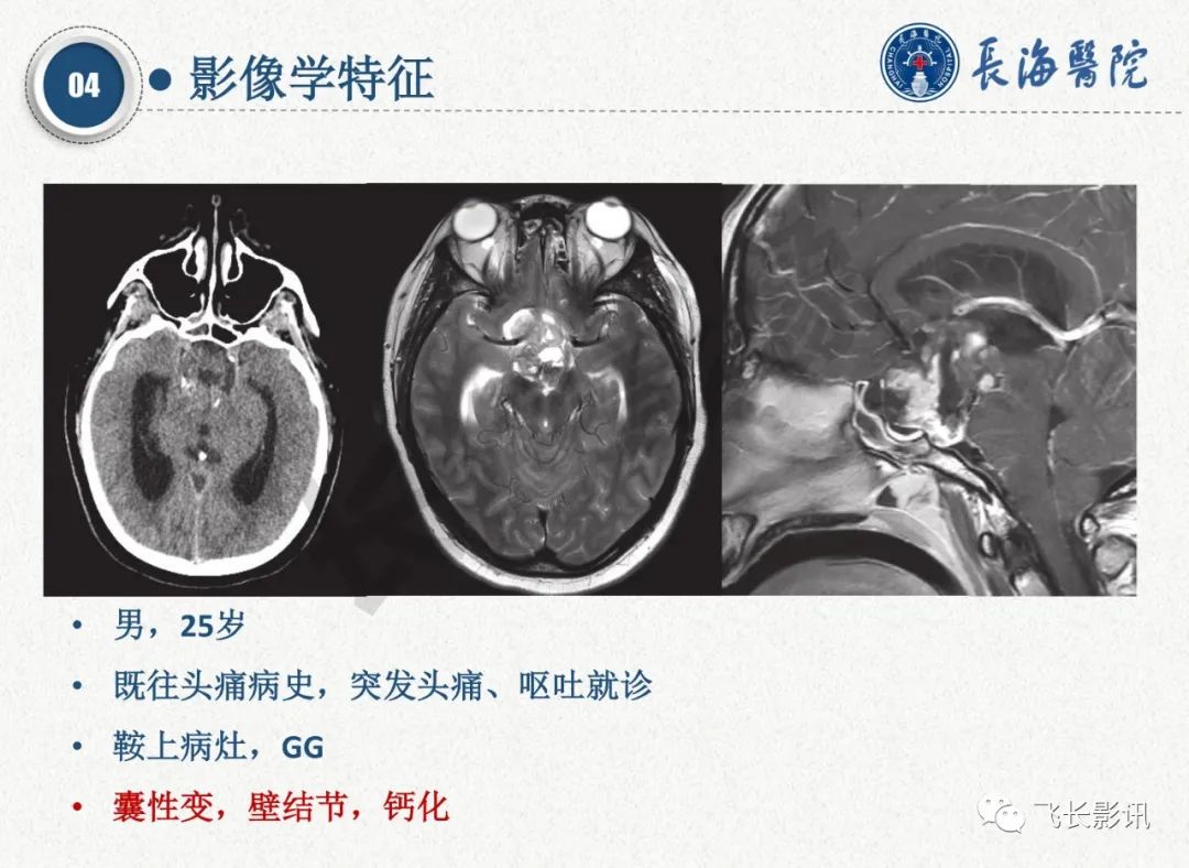 影像PPT - 【PPT】脑节细胞胶质瘤的诊断及鉴别诊断-34