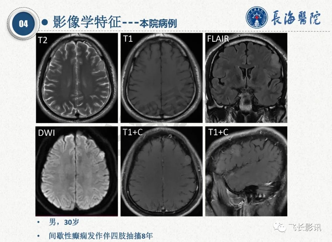 影像PPT - 【PPT】脑节细胞胶质瘤的诊断及鉴别诊断-35