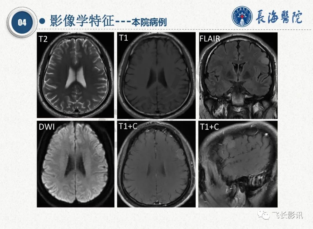 影像PPT - 【PPT】脑节细胞胶质瘤的诊断及鉴别诊断-36