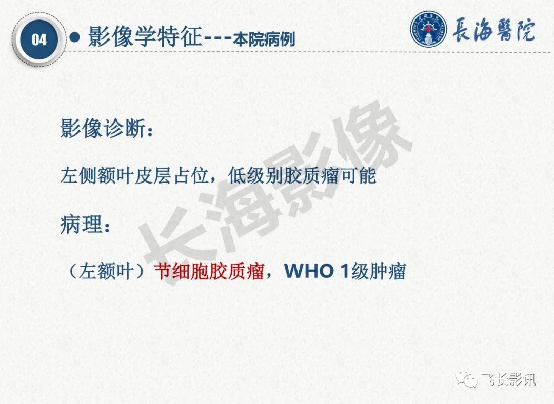 影像PPT - 【PPT】脑节细胞胶质瘤的诊断及鉴别诊断-37