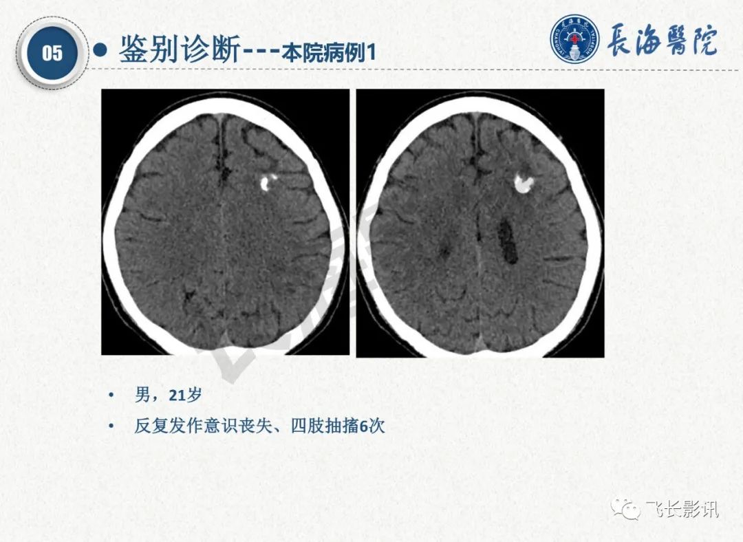 影像PPT - 【PPT】脑节细胞胶质瘤的诊断及鉴别诊断-44