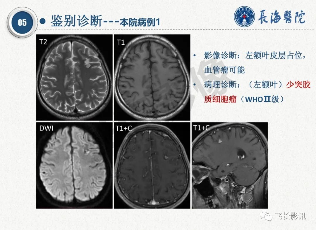影像PPT - 【PPT】脑节细胞胶质瘤的诊断及鉴别诊断-45