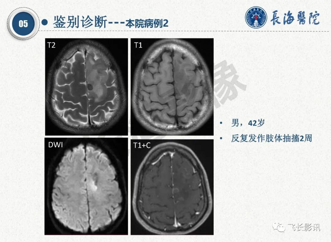 影像PPT - 【PPT】脑节细胞胶质瘤的诊断及鉴别诊断-46