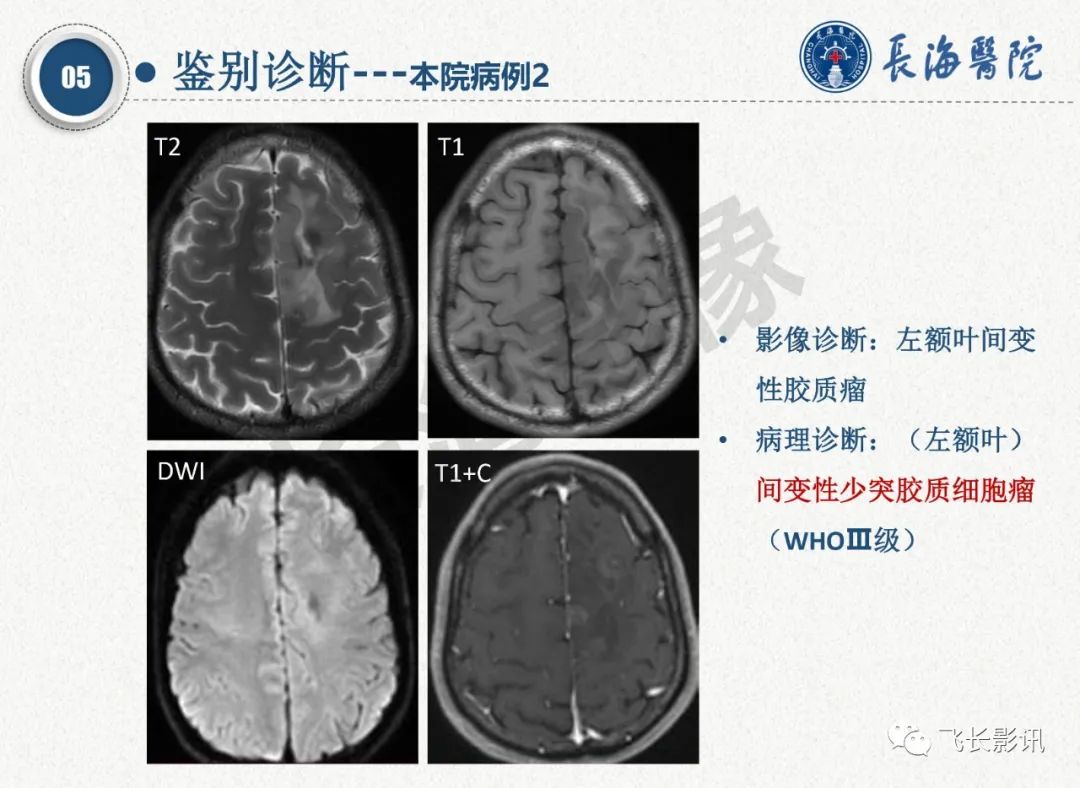 影像PPT - 【PPT】脑节细胞胶质瘤的诊断及鉴别诊断-47