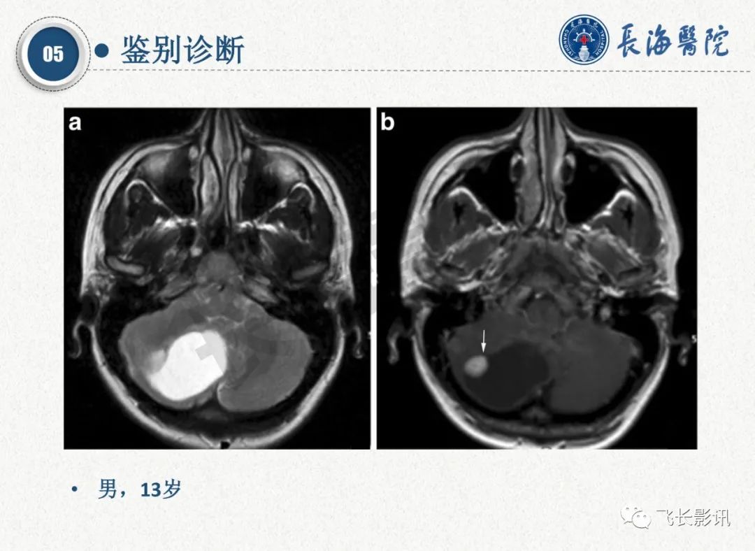 影像PPT - 【PPT】脑节细胞胶质瘤的诊断及鉴别诊断-49