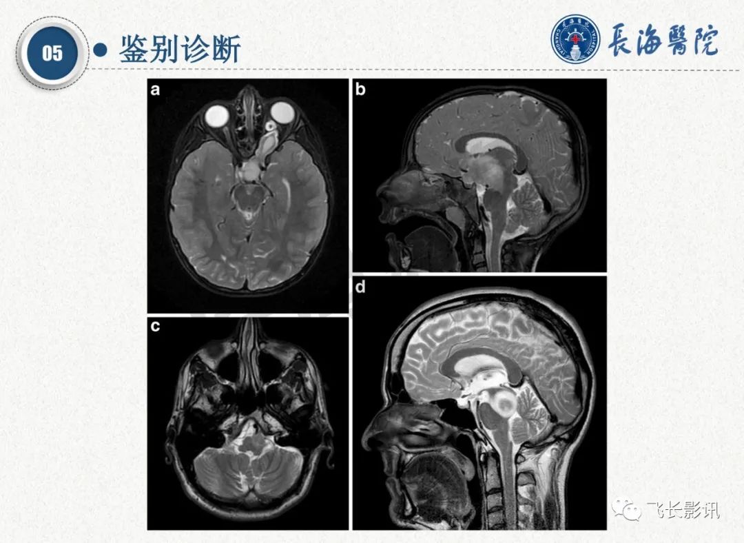 影像PPT - 【PPT】脑节细胞胶质瘤的诊断及鉴别诊断-50