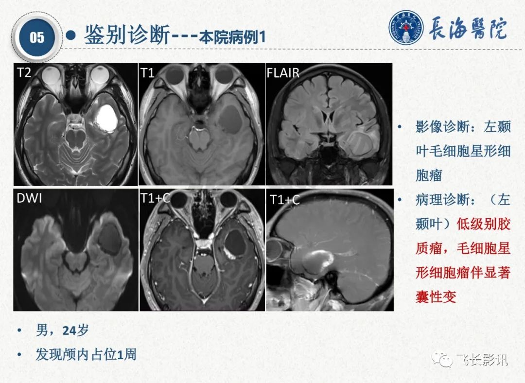 影像PPT - 【PPT】脑节细胞胶质瘤的诊断及鉴别诊断-51