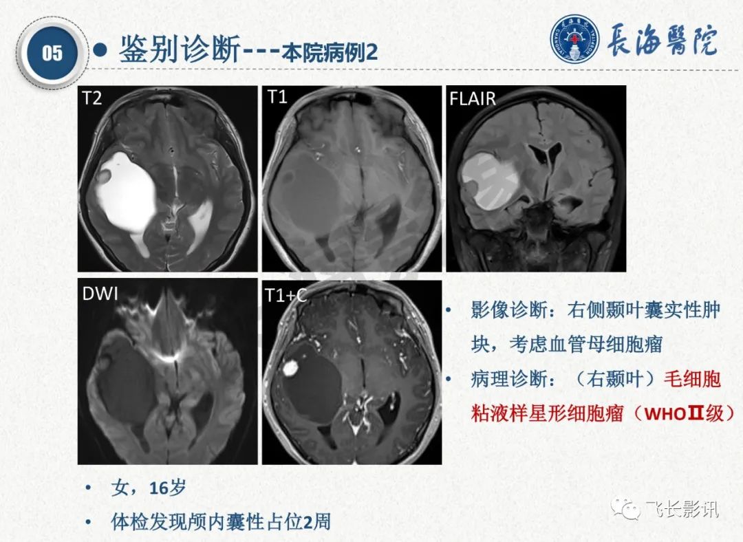 影像PPT - 【PPT】脑节细胞胶质瘤的诊断及鉴别诊断-52