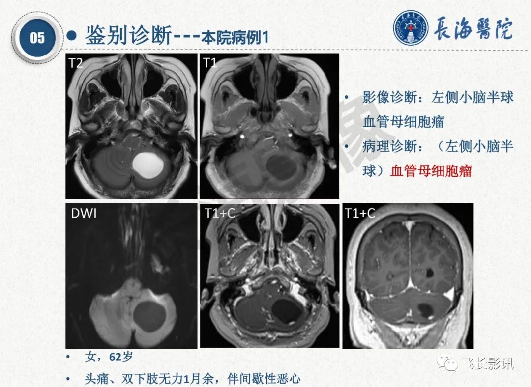 影像PPT - 【PPT】脑节细胞胶质瘤的诊断及鉴别诊断-54
