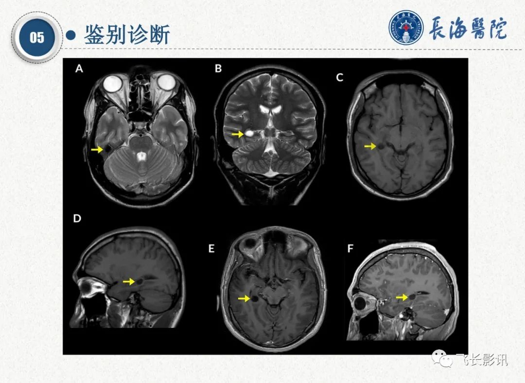 影像PPT - 【PPT】脑节细胞胶质瘤的诊断及鉴别诊断-56