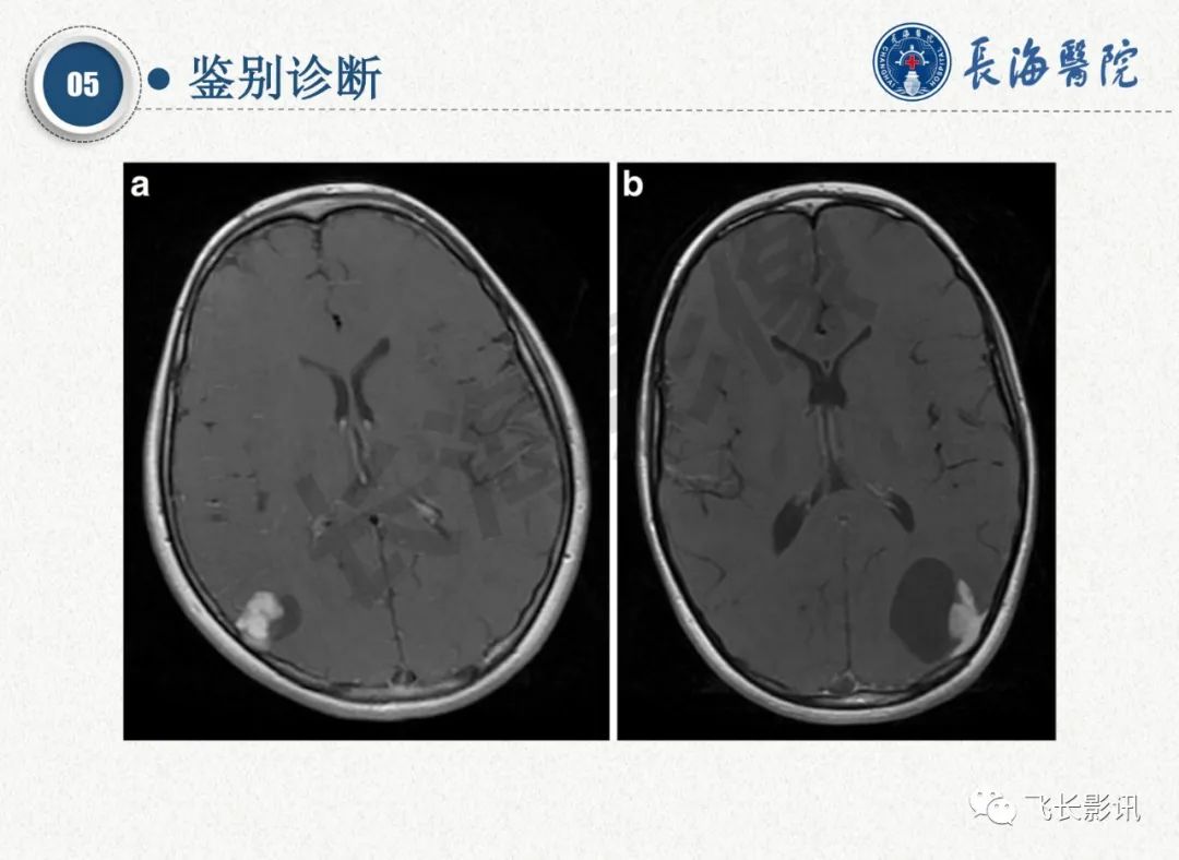 影像PPT - 【PPT】脑节细胞胶质瘤的诊断及鉴别诊断-58