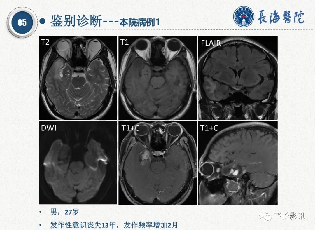 影像PPT - 【PPT】脑节细胞胶质瘤的诊断及鉴别诊断-59