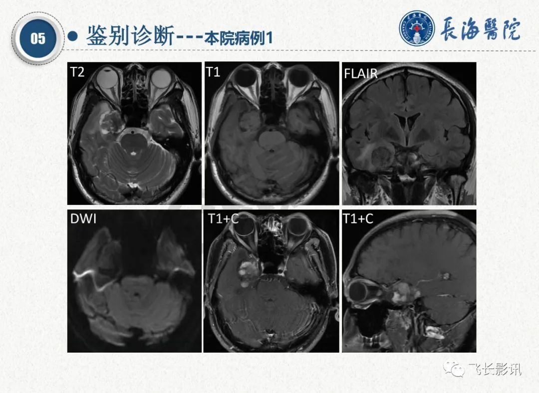 影像PPT - 【PPT】脑节细胞胶质瘤的诊断及鉴别诊断-60