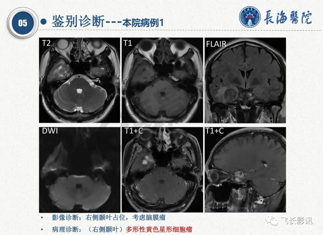 影像PPT - 【PPT】脑节细胞胶质瘤的诊断及鉴别诊断-61