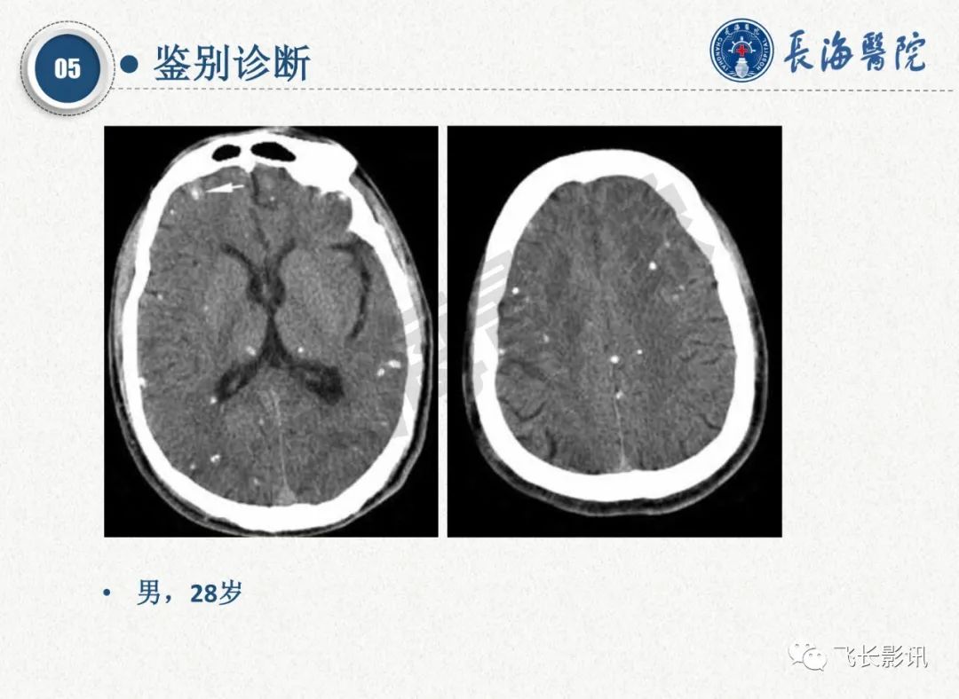 影像PPT - 【PPT】脑节细胞胶质瘤的诊断及鉴别诊断-63