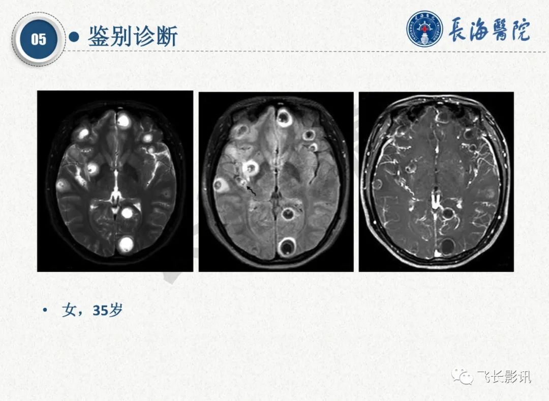 影像PPT - 【PPT】脑节细胞胶质瘤的诊断及鉴别诊断-64