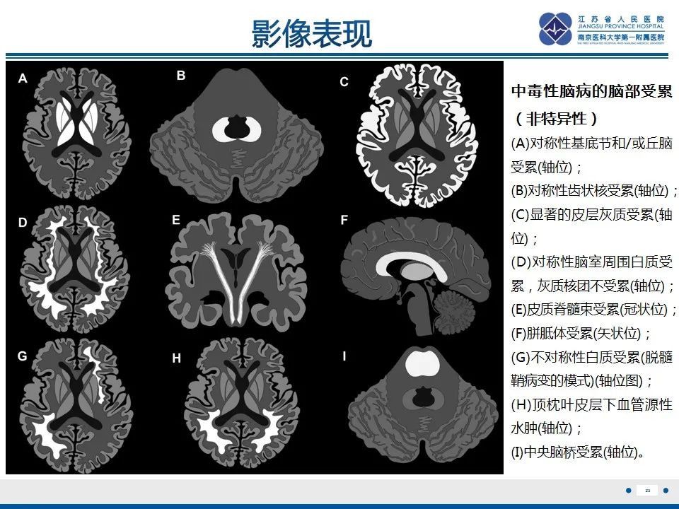 影像PPT - 【PPT】中毒性脑病-24