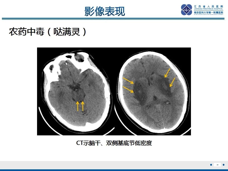 影像PPT - 【PPT】中毒性脑病-25