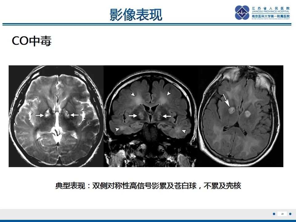 影像PPT - 【PPT】中毒性脑病-26