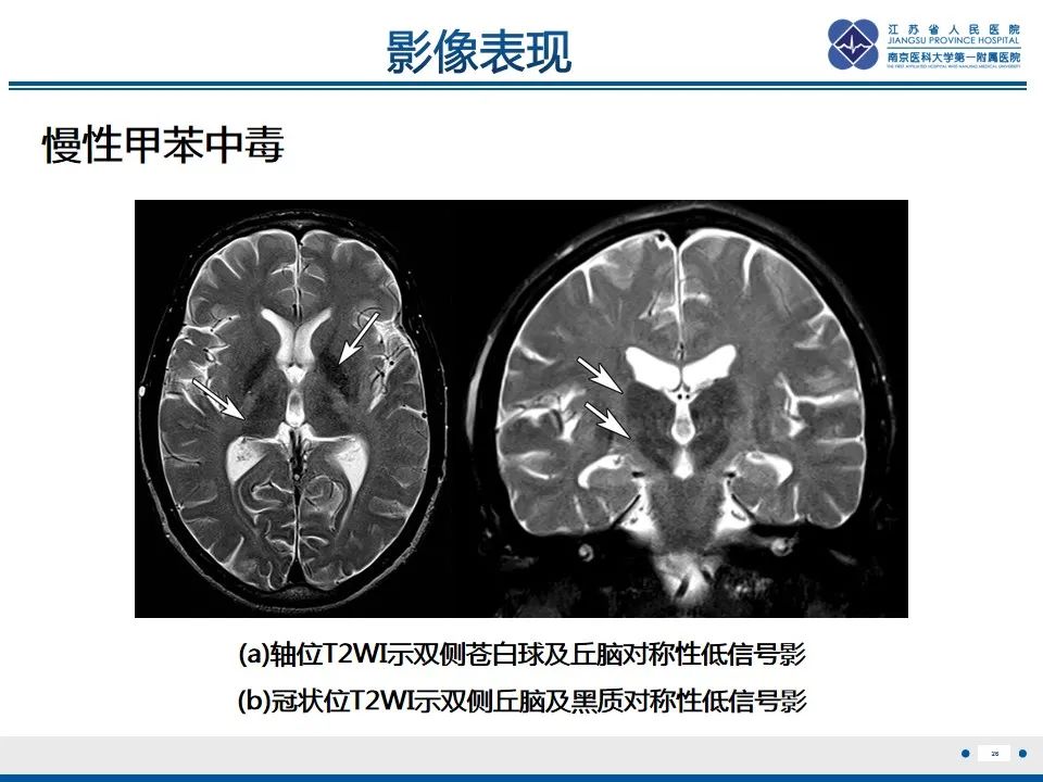 影像PPT - 【PPT】中毒性脑病-27