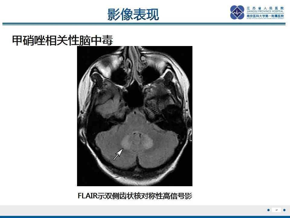 影像PPT - 【PPT】中毒性脑病-28