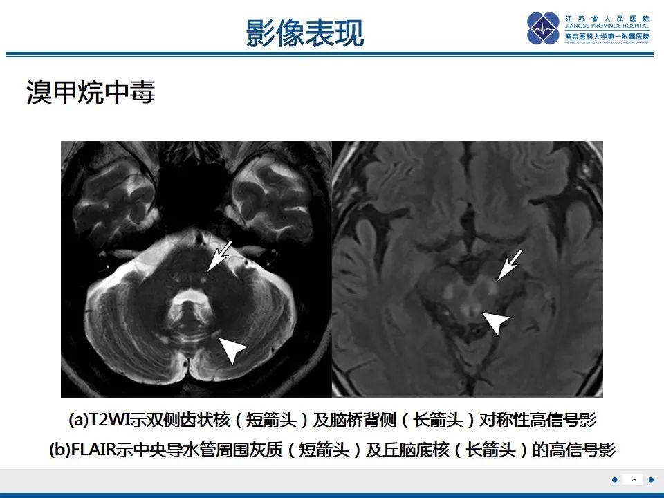 影像PPT - 【PPT】中毒性脑病-29