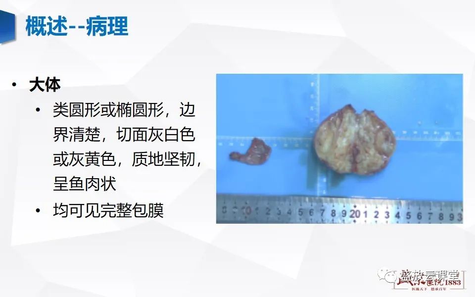 影像PPT - 【PPT】纵隔节细胞神经瘤-4