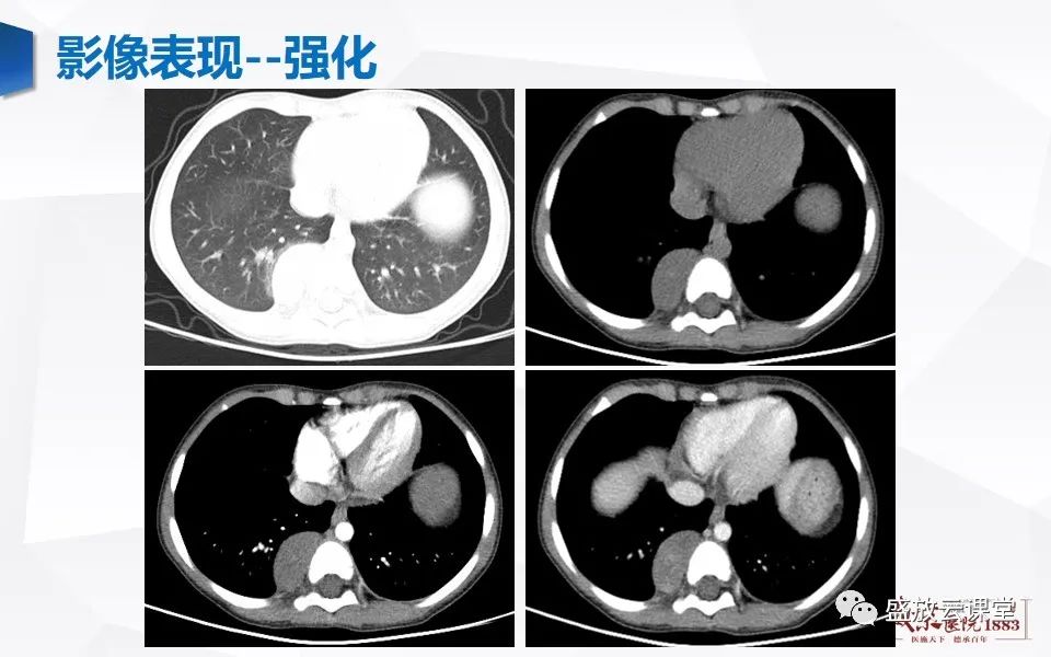 影像PPT - 【PPT】纵隔节细胞神经瘤-14