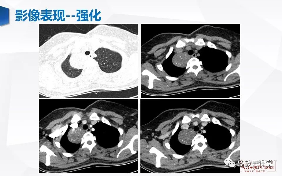 影像PPT - 【PPT】纵隔节细胞神经瘤-15