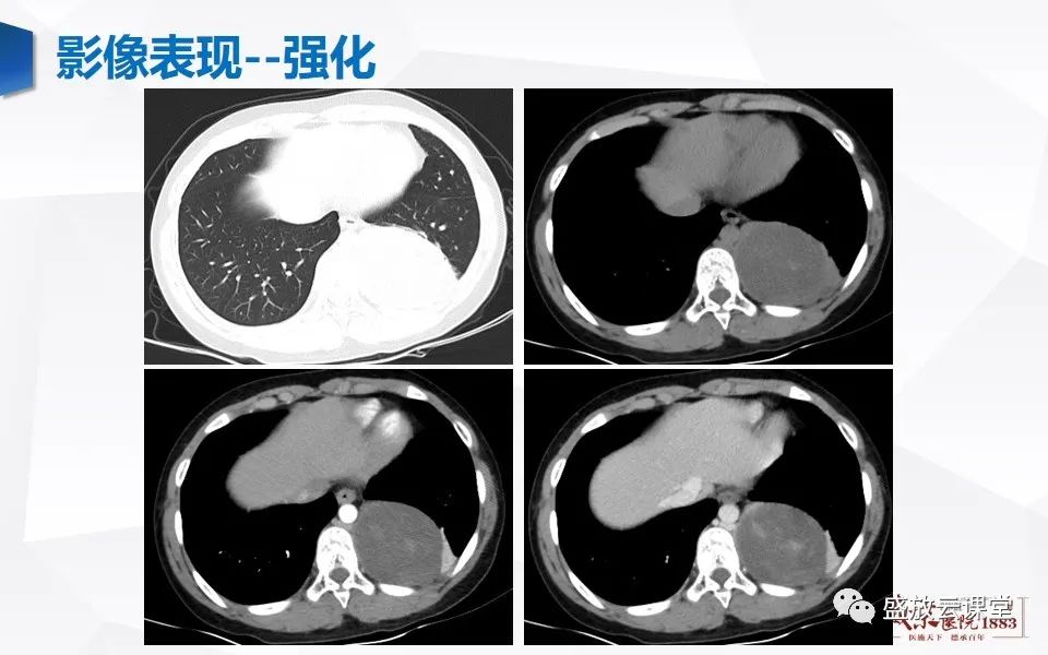 影像PPT - 【PPT】纵隔节细胞神经瘤-16