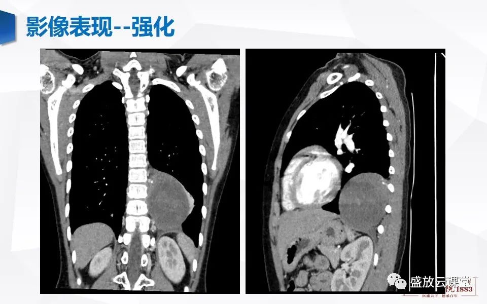 影像PPT - 【PPT】纵隔节细胞神经瘤-17