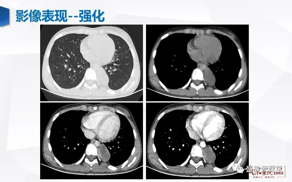影像PPT - 【PPT】纵隔节细胞神经瘤-18