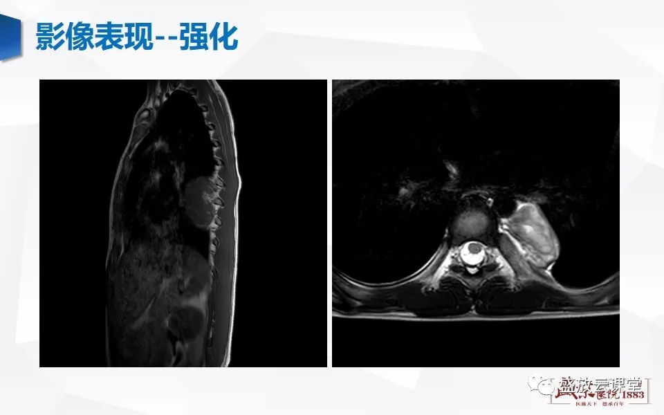 影像PPT - 【PPT】纵隔节细胞神经瘤-19
