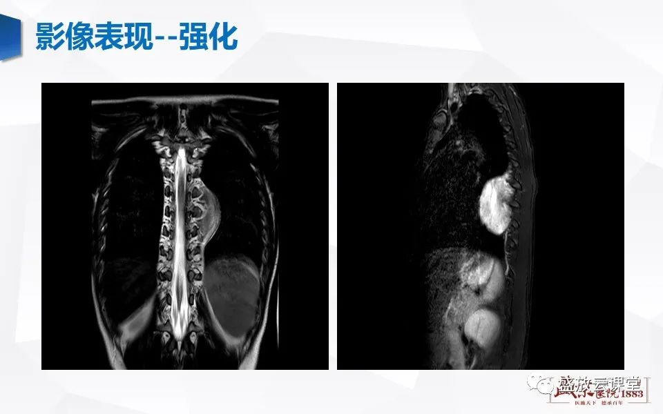影像PPT - 【PPT】纵隔节细胞神经瘤-20