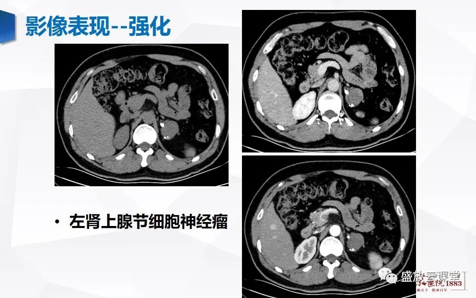 影像PPT - 【PPT】纵隔节细胞神经瘤-21