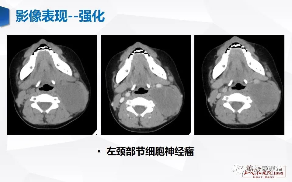 影像PPT - 【PPT】纵隔节细胞神经瘤-22