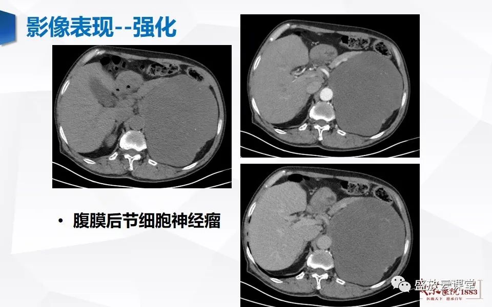 影像PPT - 【PPT】纵隔节细胞神经瘤-23