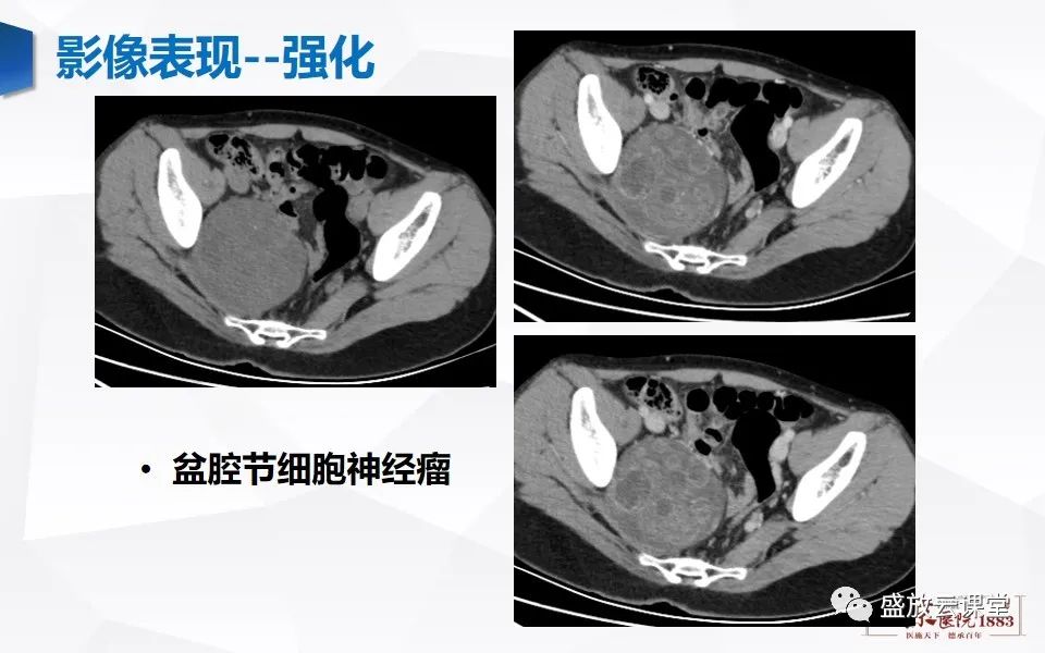 影像PPT - 【PPT】纵隔节细胞神经瘤-24