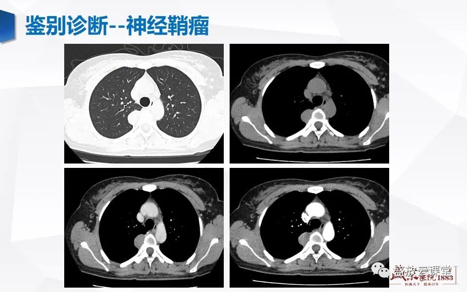 影像PPT - 【PPT】纵隔节细胞神经瘤-27