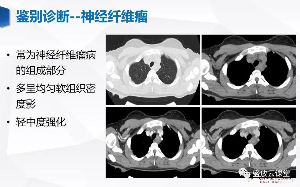 影像PPT - 【PPT】纵隔节细胞神经瘤-28