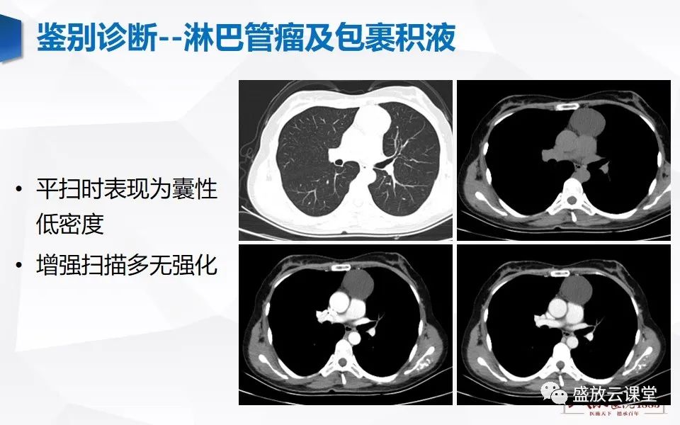 影像PPT - 【PPT】纵隔节细胞神经瘤-29