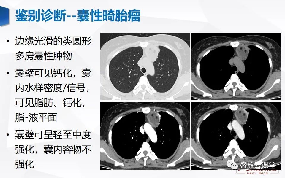 影像PPT - 【PPT】纵隔节细胞神经瘤-30