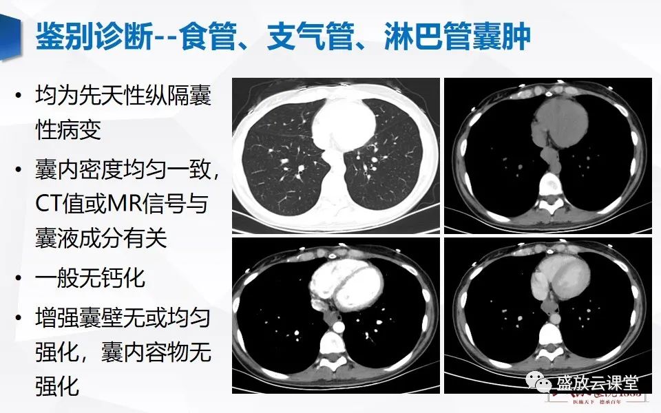 影像PPT - 【PPT】纵隔节细胞神经瘤-31