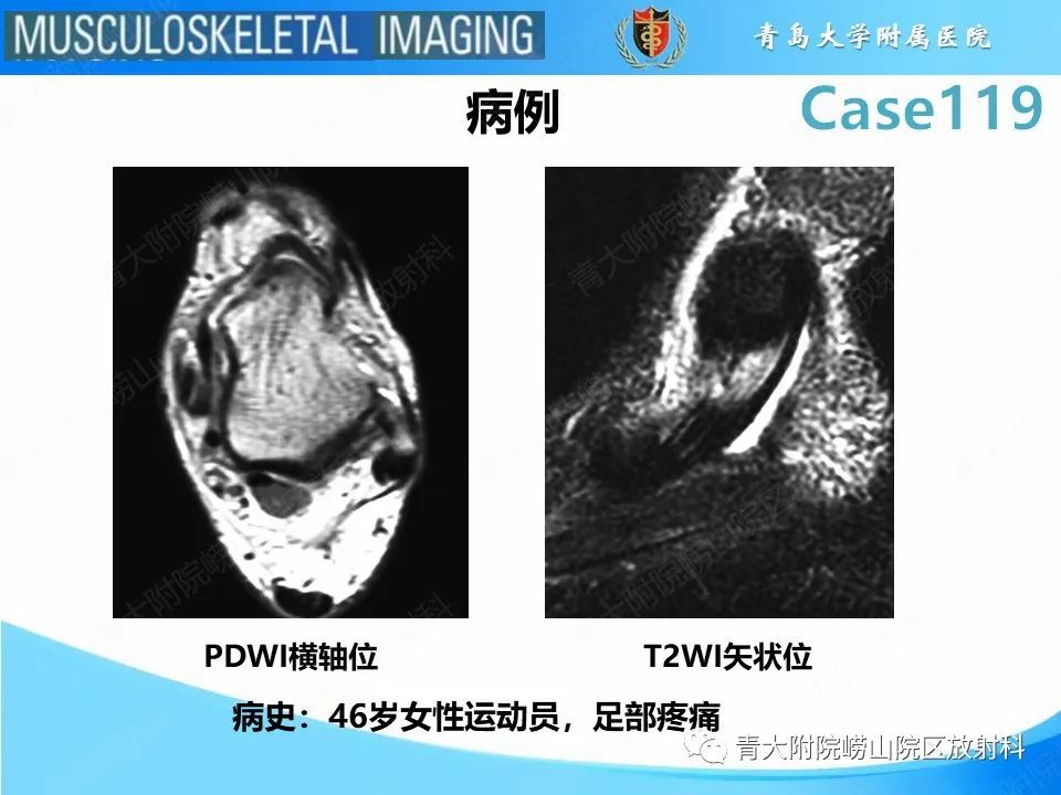 影像PPT - 【PPT】胫骨后肌腱撕裂-2