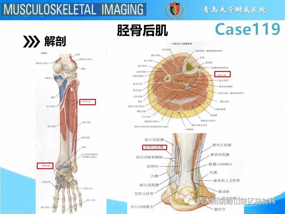 影像PPT - 【PPT】胫骨后肌腱撕裂-11