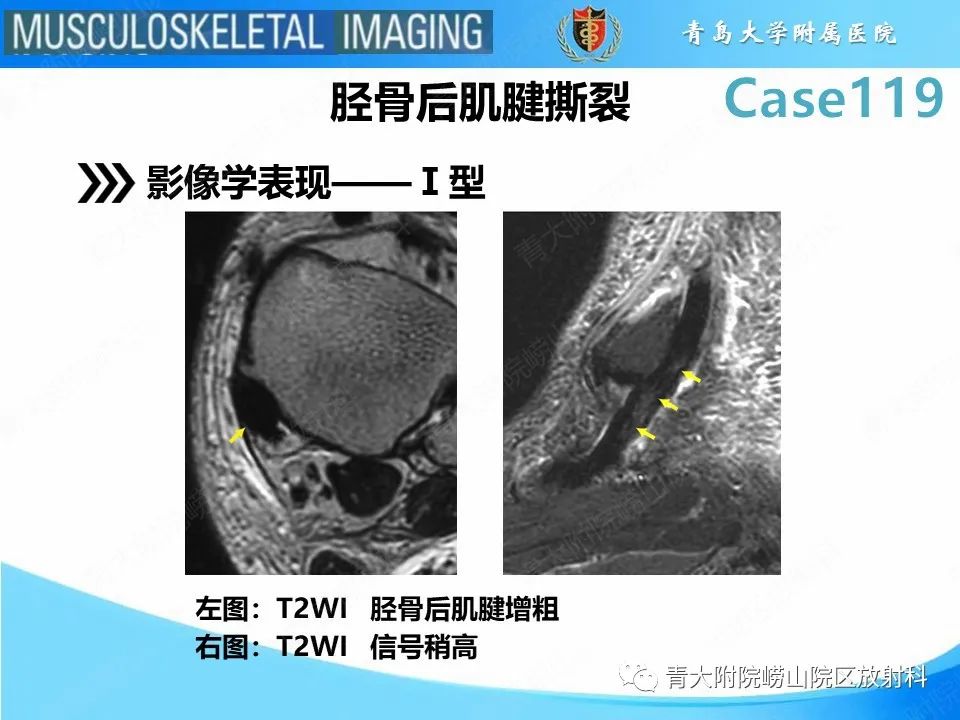 影像PPT - 【PPT】胫骨后肌腱撕裂-15