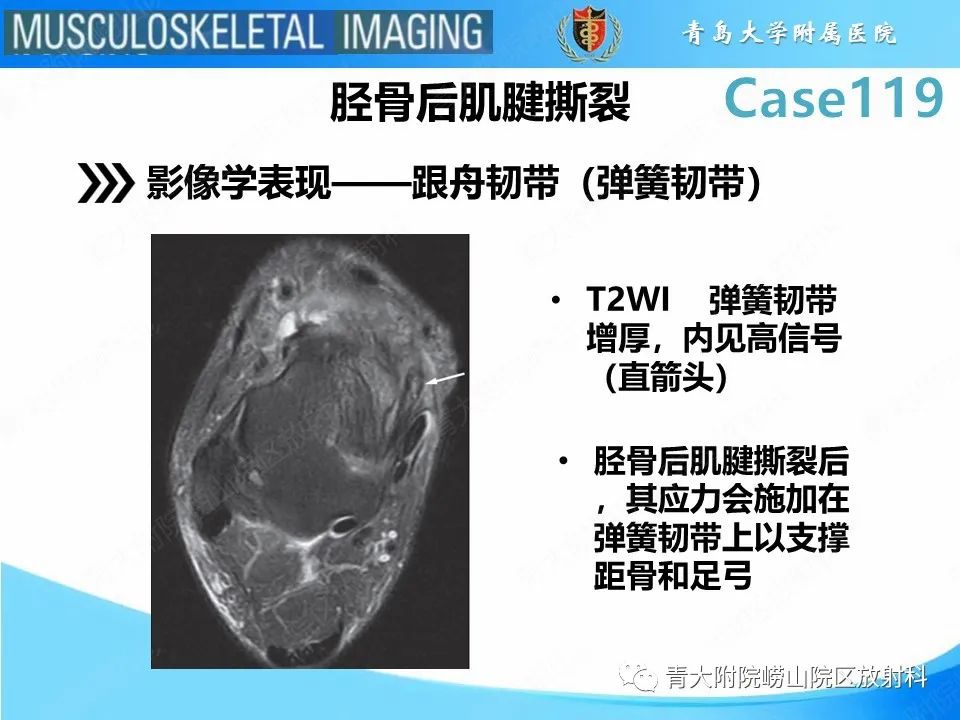 影像PPT - 【PPT】胫骨后肌腱撕裂-18