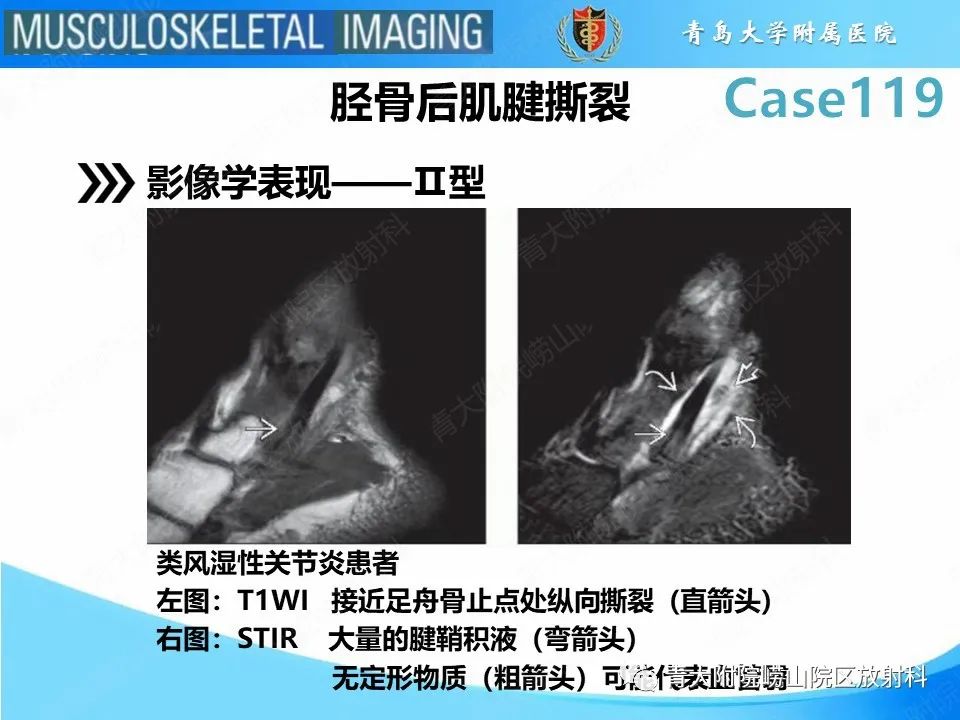 影像PPT - 【PPT】胫骨后肌腱撕裂-16